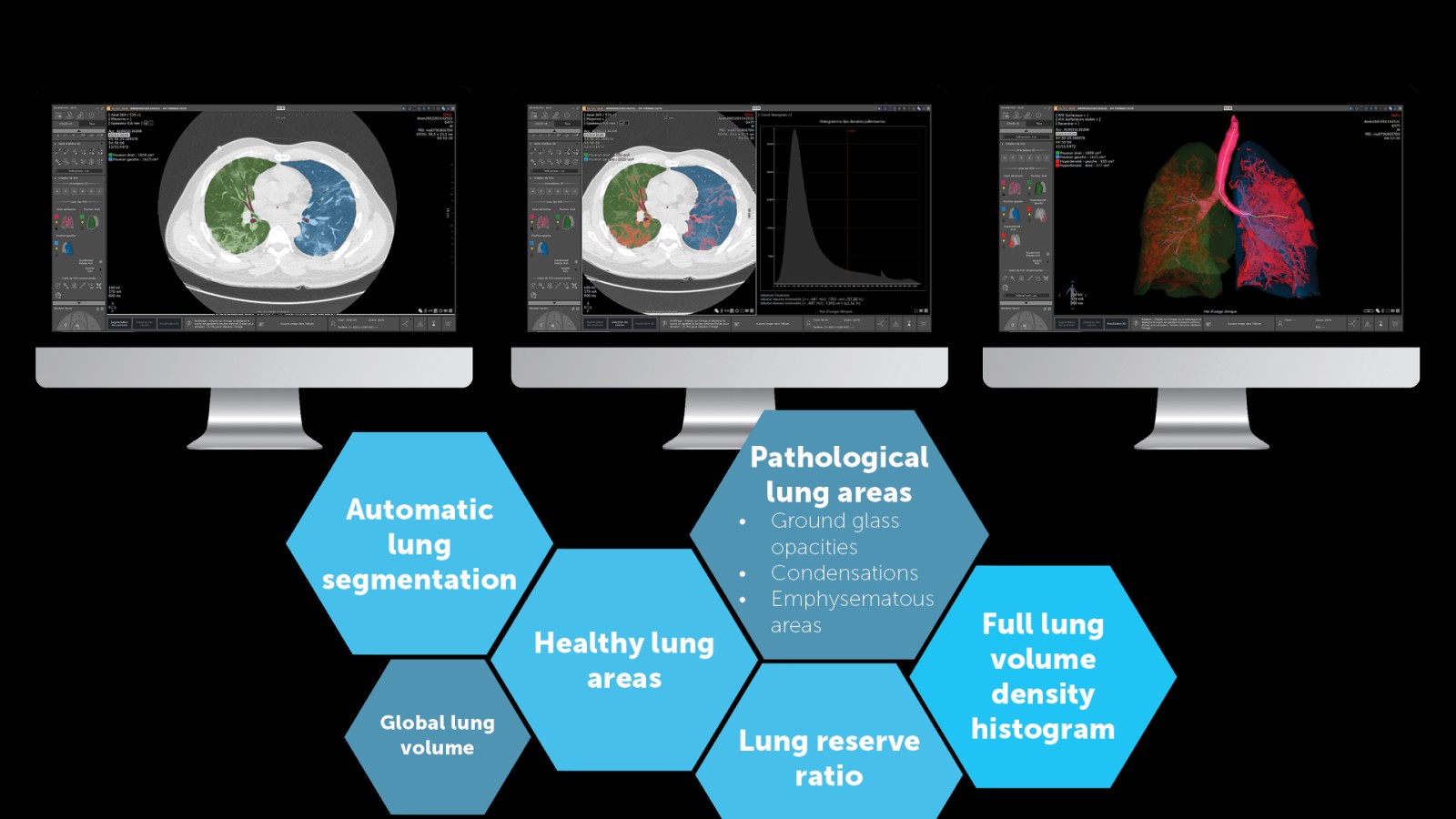Специфічні протоколи обробки КТ зображень легень від компанії Іntrasense (Франція)